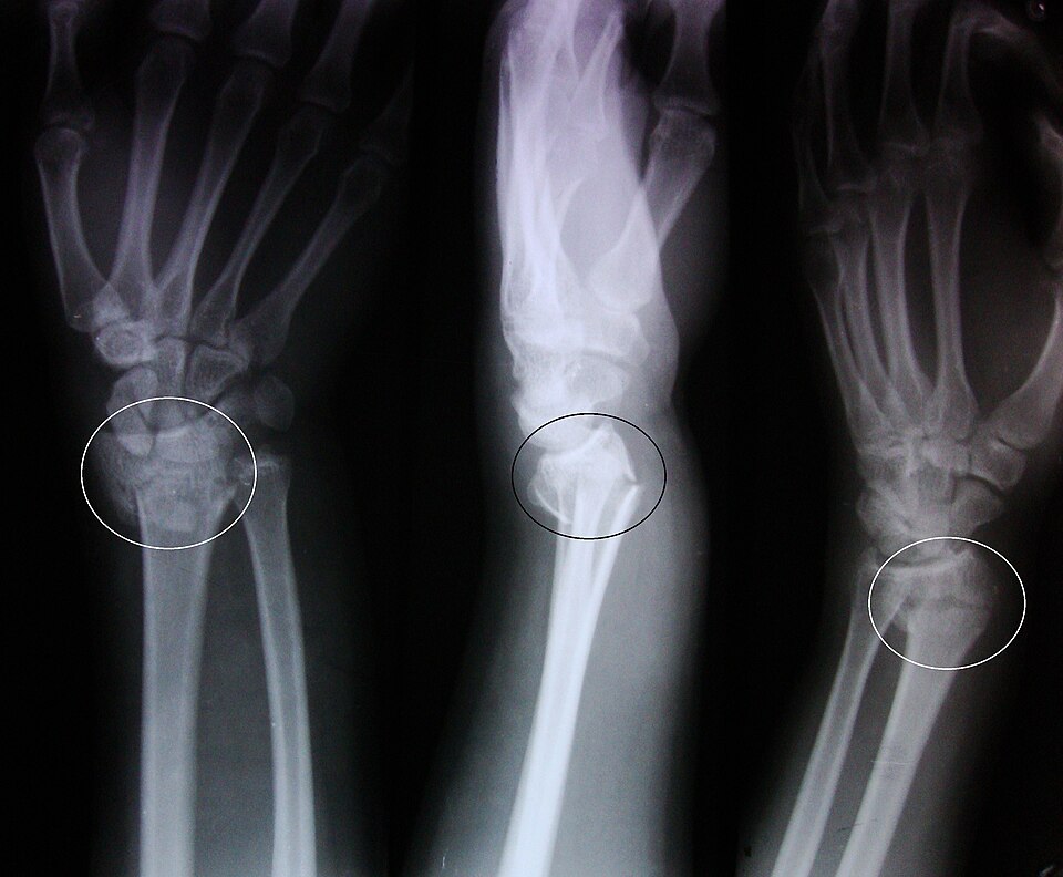 Genuine wrist radiographs showing a Colles fracture