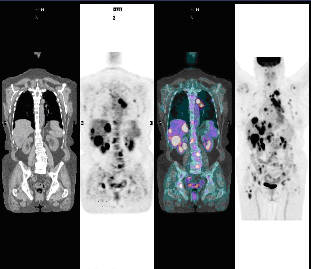 Genuine whole-body PET/CT study with diffuse metastatic disease
