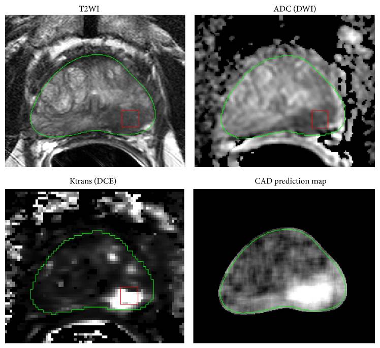 Genuine multiparametric prostate MRI showing T2, ADC, perfusion and prediction-map panels