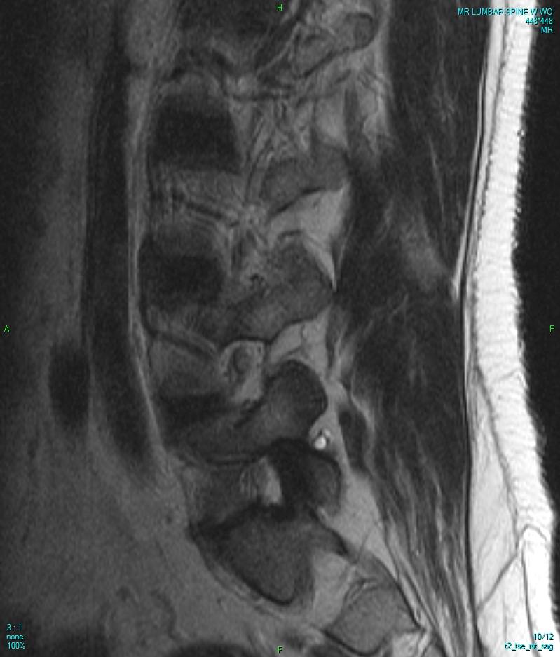 Genuine sagittal T2-weighted MRI of the lumbar spine
